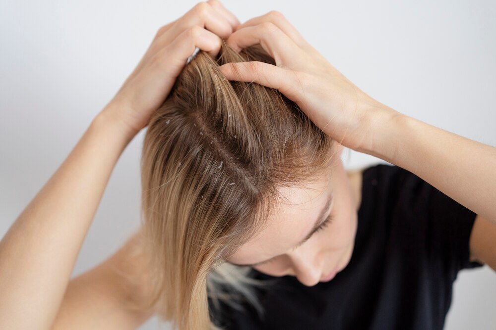 Close up woman with dandruff issues